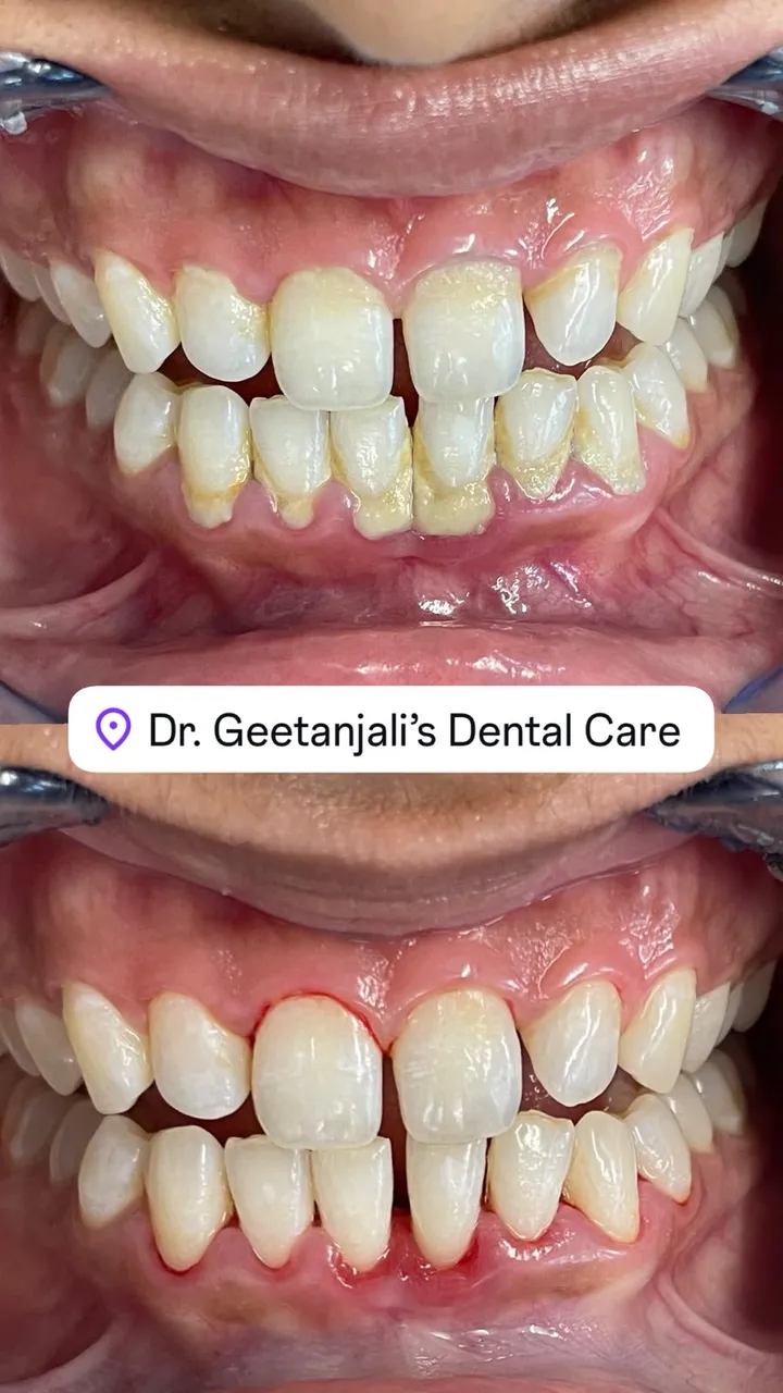 Professional scaling and polishing, before and after