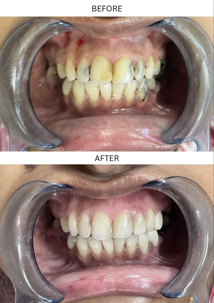 Smile makeover, before and after