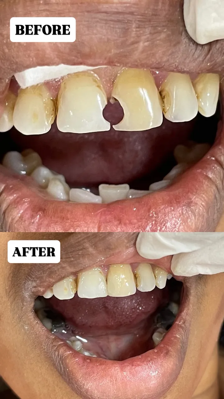 Tooth-coloured composite filling, before and after
