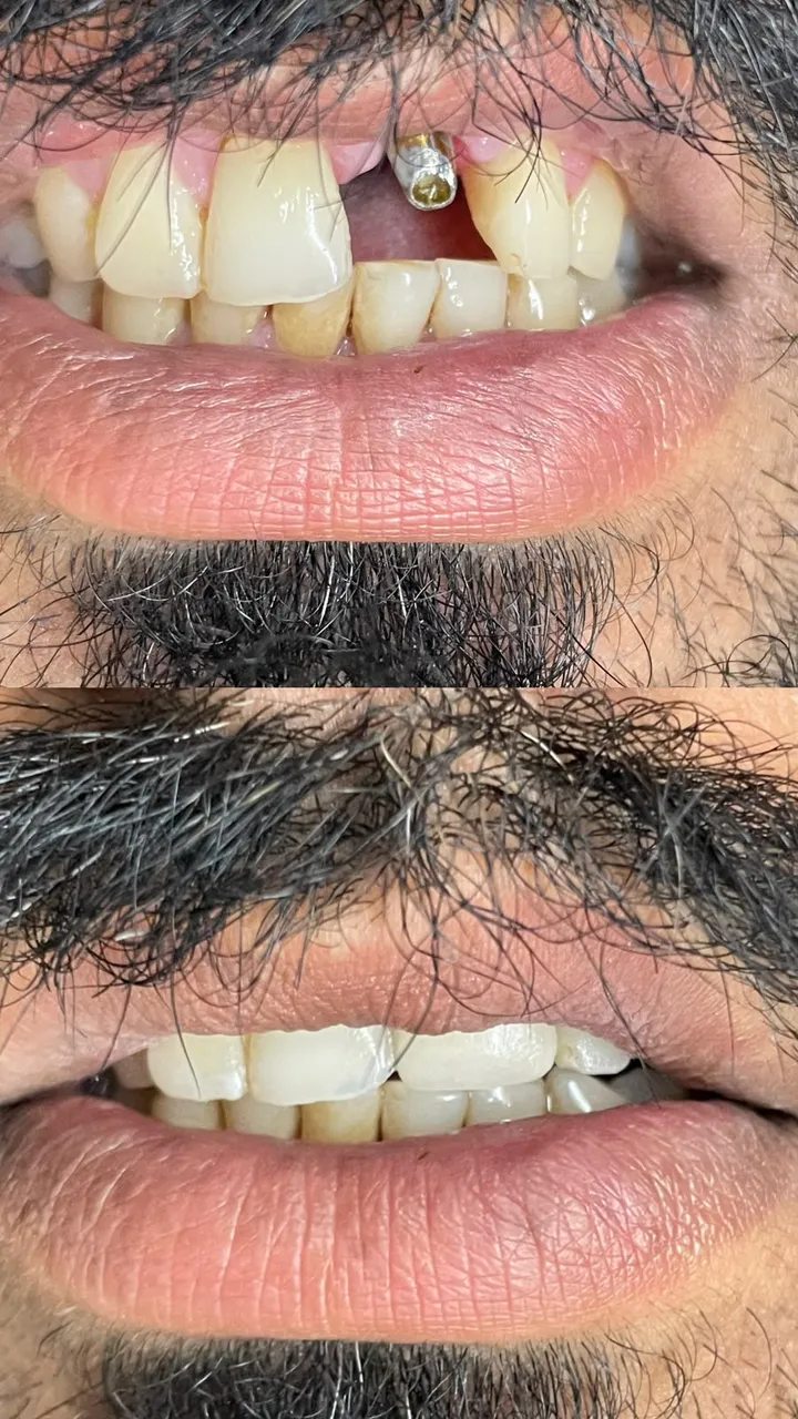 Missing front tooth restored with a dental implant, before and after