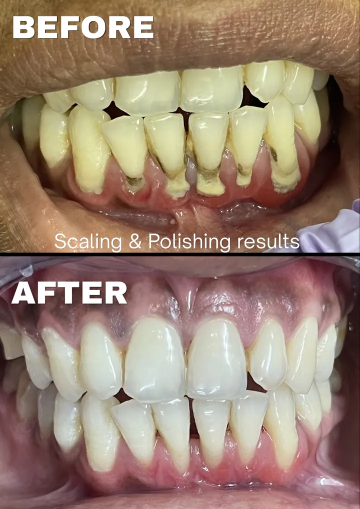 Scaling and polishing to remove stains and tartar, before and after